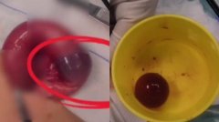 误食“水宝宝”玩具 中国幼童肠道梗阻